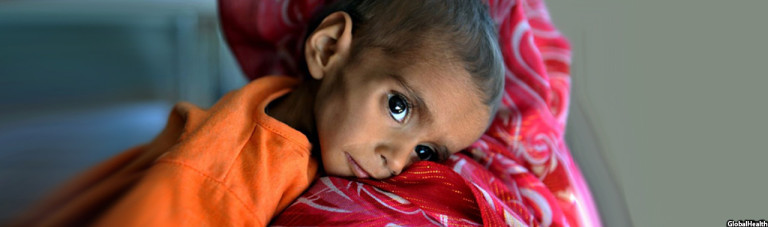 ناامنی و فقر؛ دلایل عمده سوء تغذیه 2 میلیون کودک در افغانستان