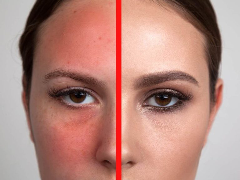 10 درمان های خانگی برای کاهش قرمزی صورت