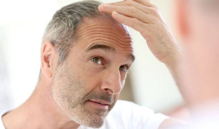 کاشت موی طبیعی در افراد مسن ممکن است؟