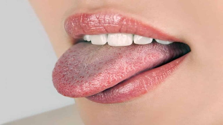 11 درمان خانگی برای سفید شدن زبان و نکات پیشگیری از آن
