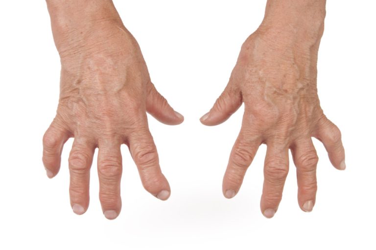 آرتریت انگشتان دست: علل، روش‌های درمان و پیشگیری از درد انگشتان