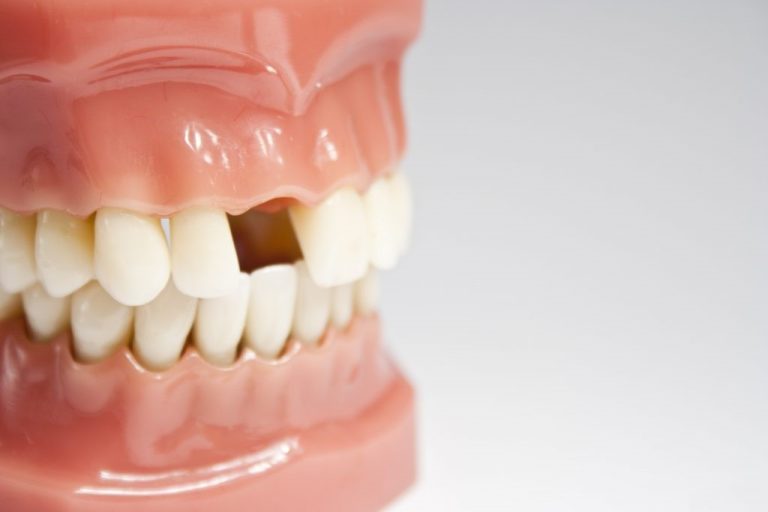 روش‌های جایگزین دندان افتاده و ماندگاری آن‌ها