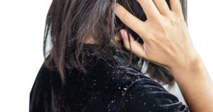 آیا روغن زدن به مو، باعث افزایش شوره سر می شود؟