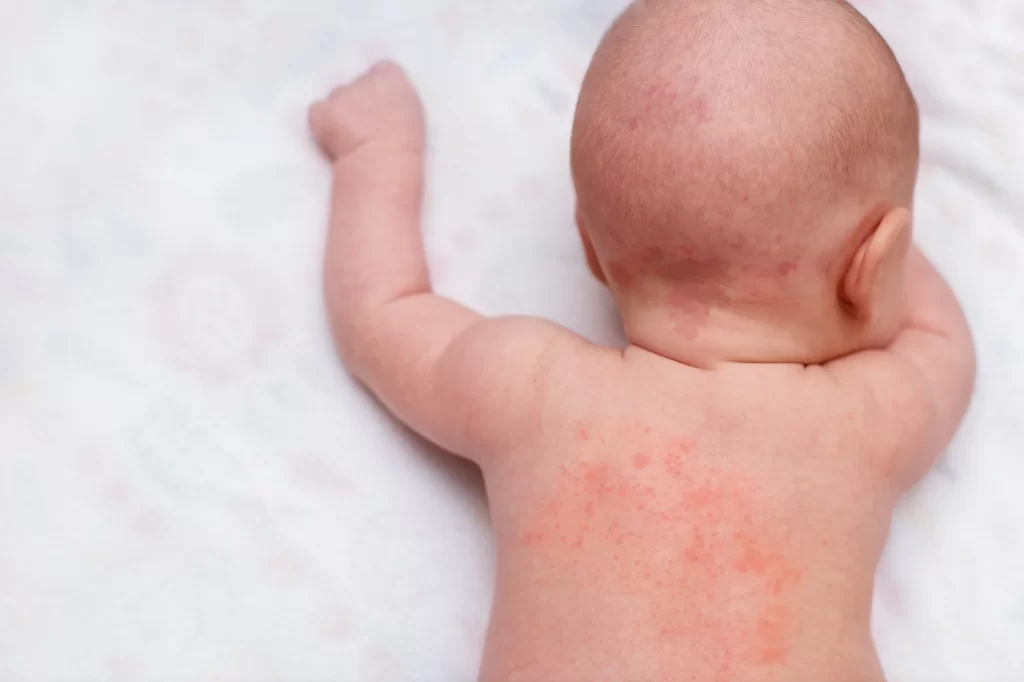 اگزمای پوستی در نوزادان