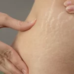 درمان ترک پوستی؛ ۶ ترکیب موثر با روغن زیتون که ترک پوست را محو می‌کنند