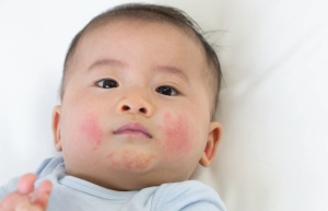 اگزمای پوستی در نوزادان چه فرقی با آکنه دارد؟