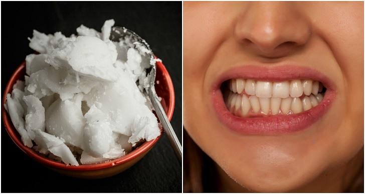 سفید کردن دندان ها با روغن نارگیل