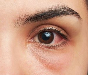 درمان خانگی چشم صورتی به کمک ۸ راهکار موثر