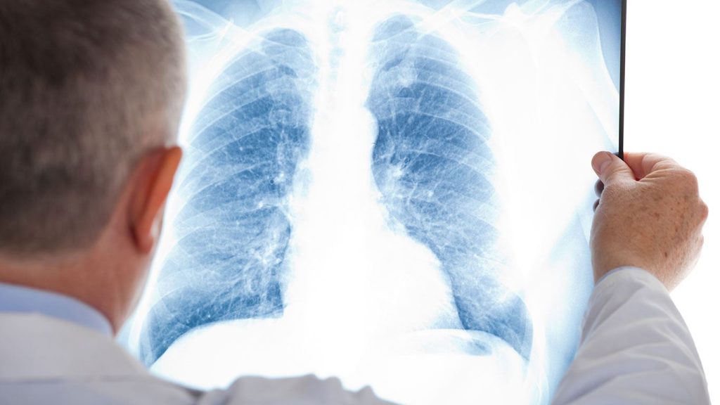 پزشکان از نحوه ترمیم ریه های افراد سیگاری می‌گویند