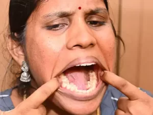 ثبت رکورد جهانی بیشترین دندان به نام یک زن هندی