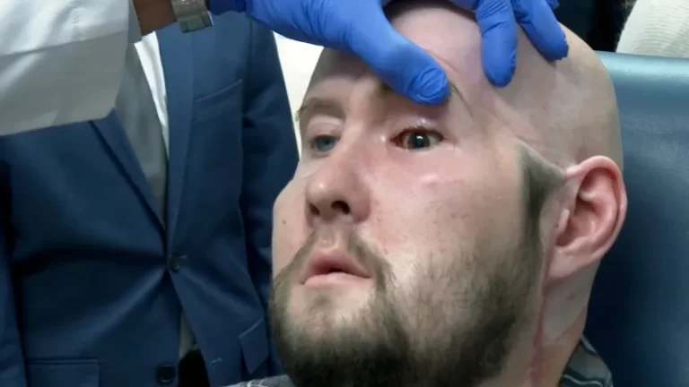 برای اولین بار، عمل پیوند چشم کامل در آمریکا انجام شد!