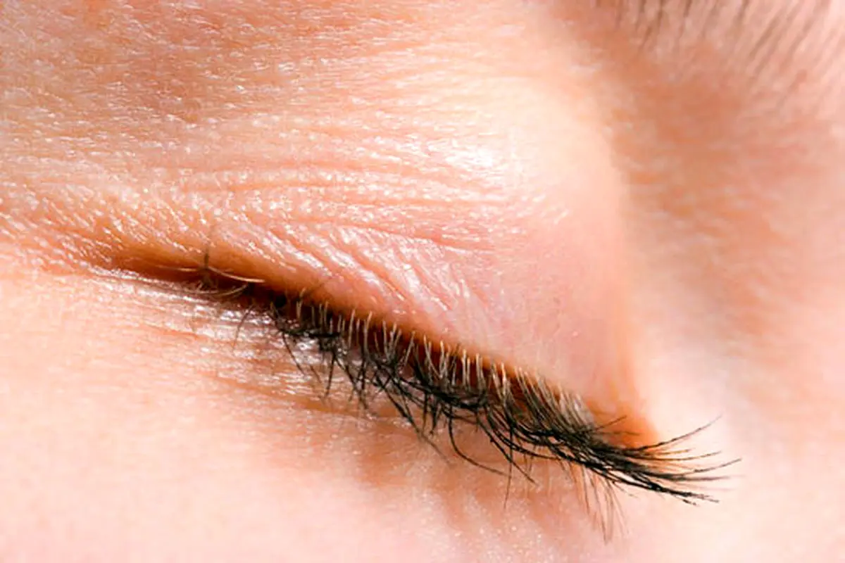 علت پریدن پلک چشم چپ: علل، تشخیص و درمان