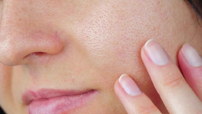 نقش سبک زندگی در کاهش منافذ باز بینی