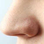 درمان خانگی منافذ باز روی بینی | راهکارهای طبیعی برای پوستی صاف‌تر